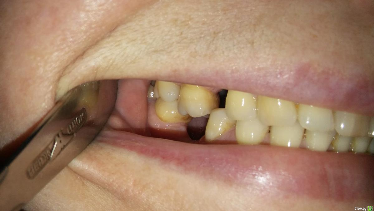 Выдвинулся зуб: как ортодонтия помогает полноценному протезированию