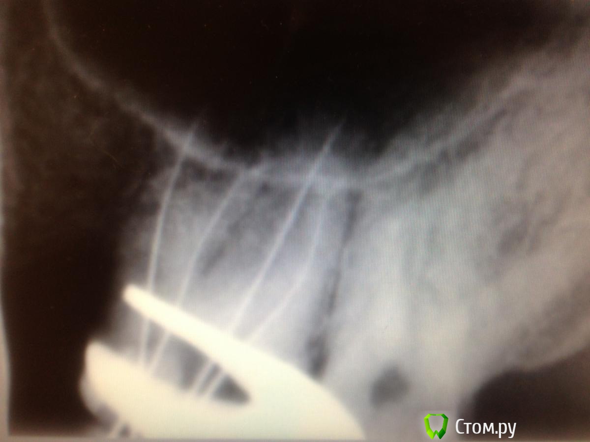 Перфорация гайморовой пазухи после лечения каналов зубов