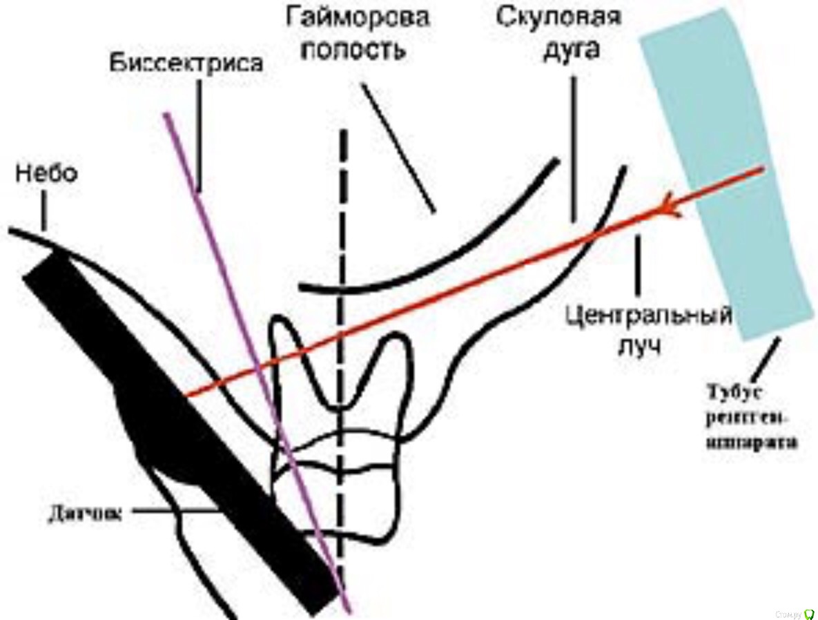 Некачественный рентген - Терапия - Стоматология для всех