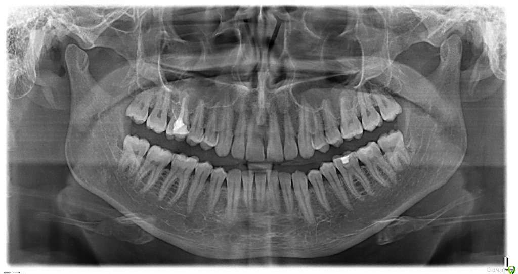 Рентген зубов фото