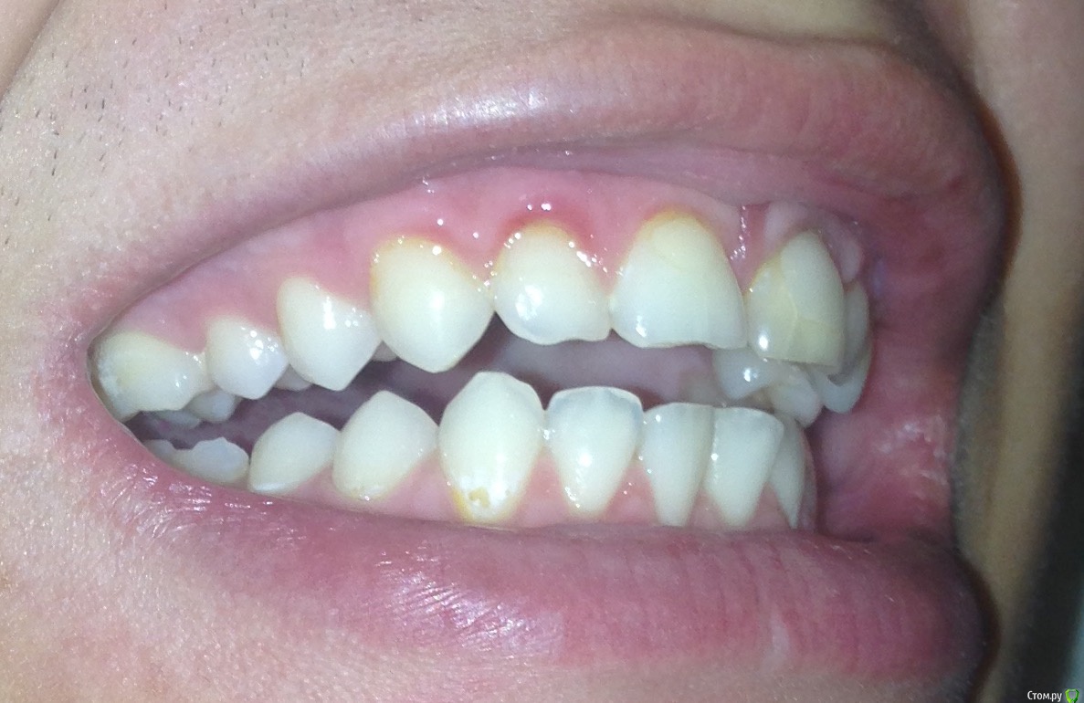 Как выглядит клиновидный дефект зуба