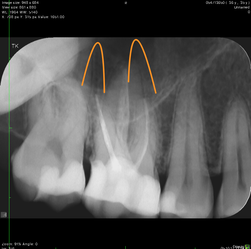 Пломбировка каналов 6 зуба. Пульпит верхней 6ки рентген. Трехканальный зуб снимок.