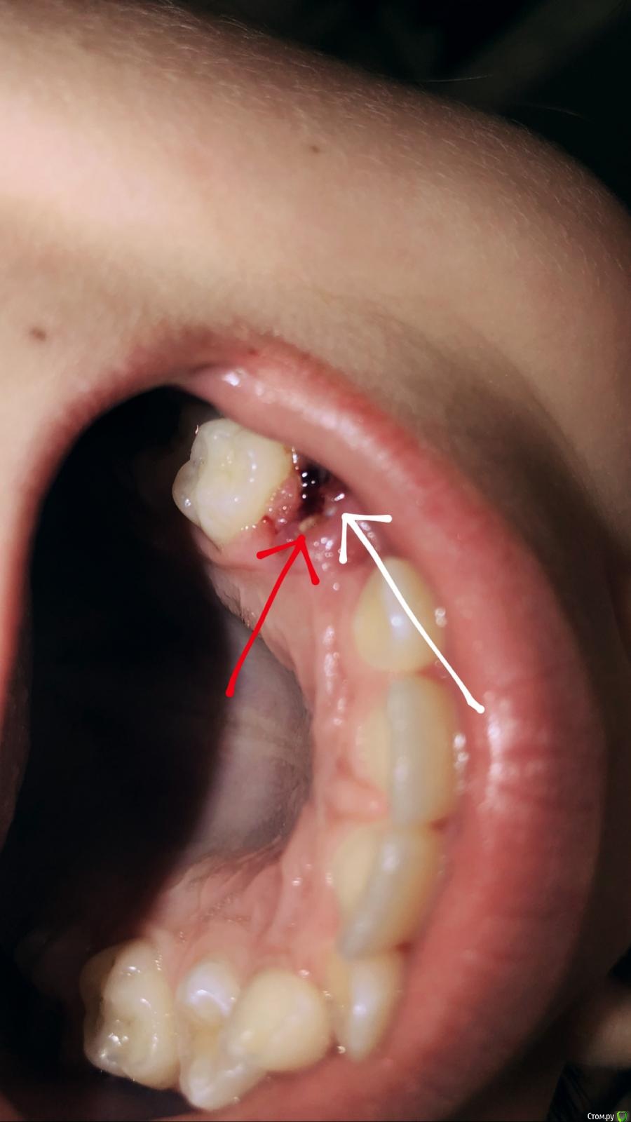 после минета болит десна фото 98