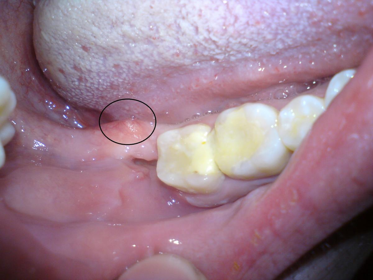 Удаление зубов — показания и этапы операции