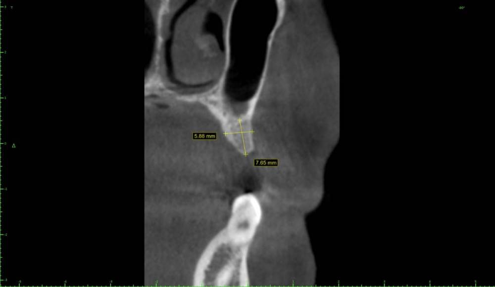 ������� ����� �����������1-Implant View.jpg