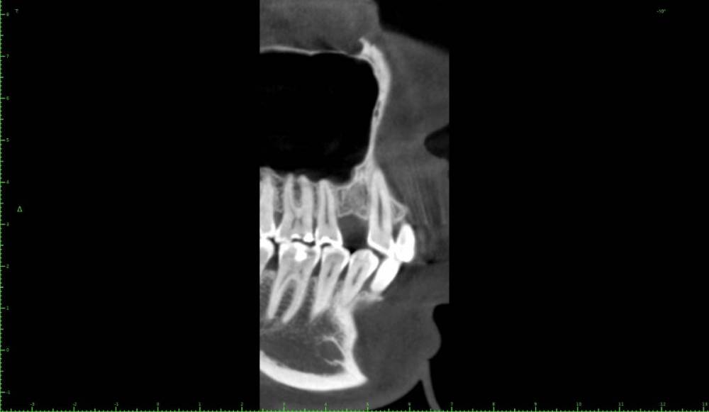 ������� ����� �����������0-Implant View.jpg