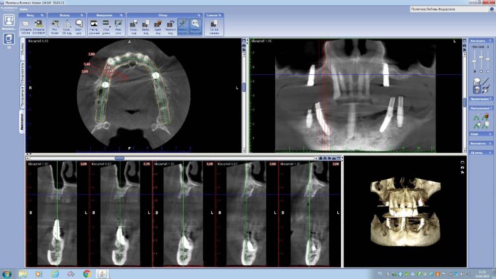 Политова после имплантации 4 месяца.jpg