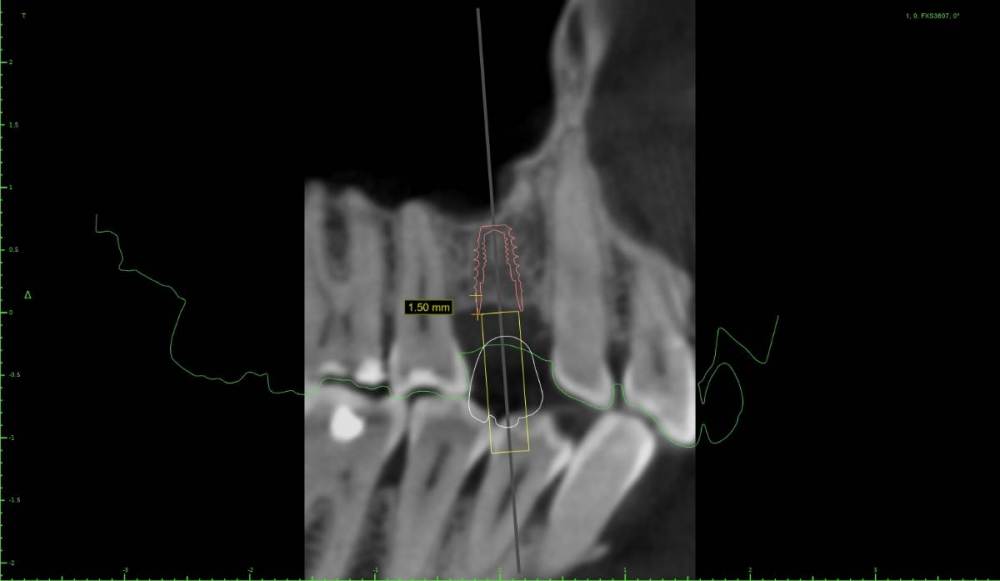 chtps2-Implant View.jpg