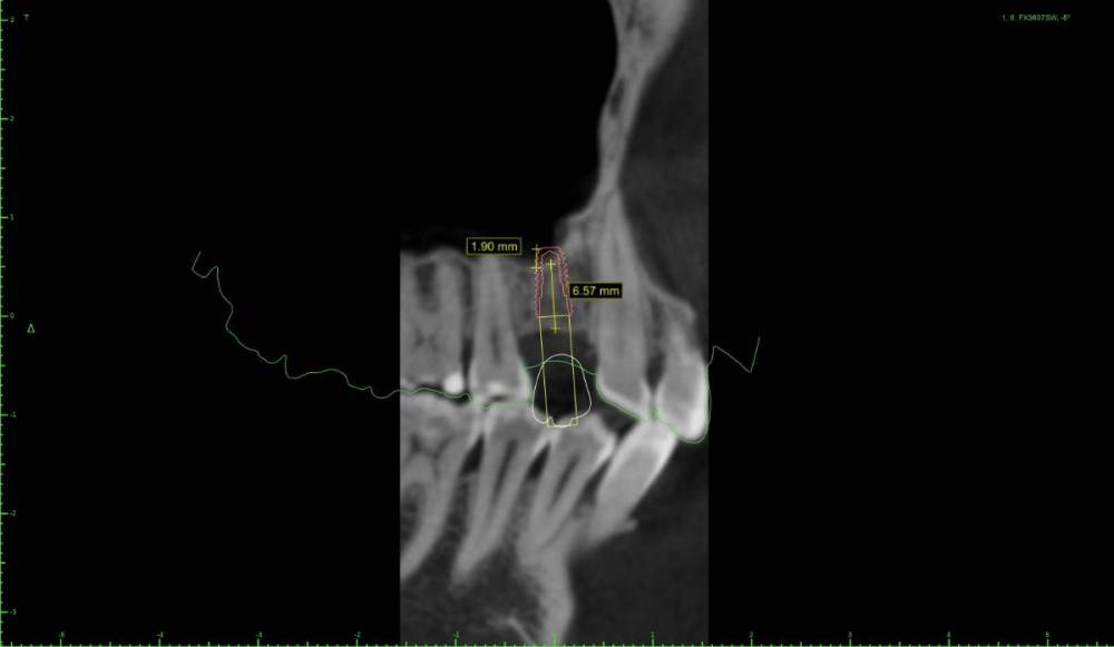 chtps0-Implant View.jpg
