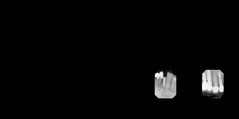 Имплант №23 слева.jpeg