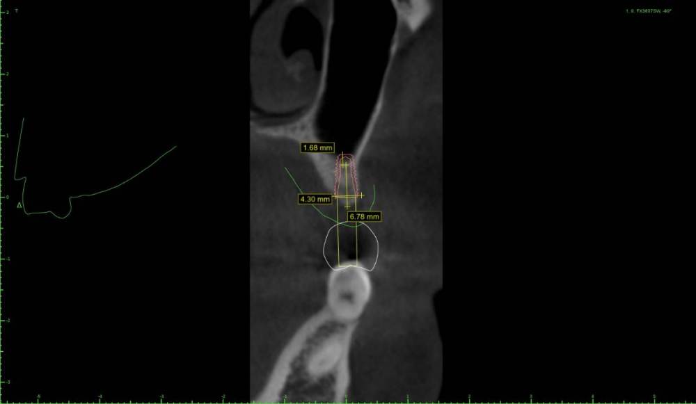 chtps1-Implant View.jpg