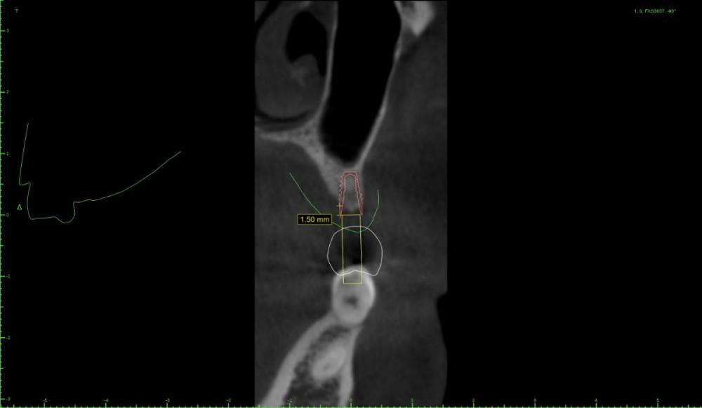 chtps3-Implant View.jpg