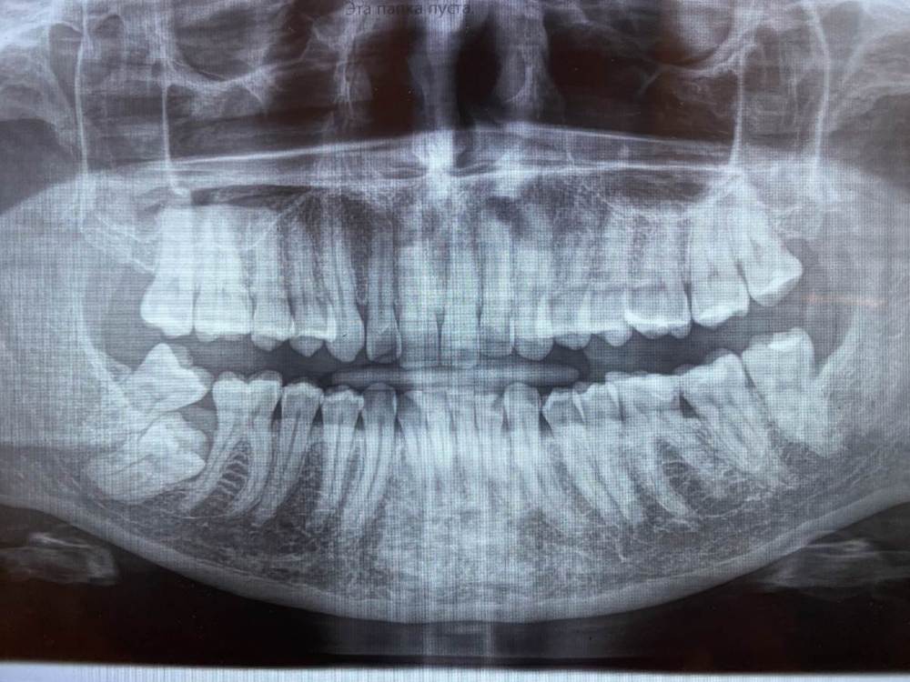 рентген зубов.jpg