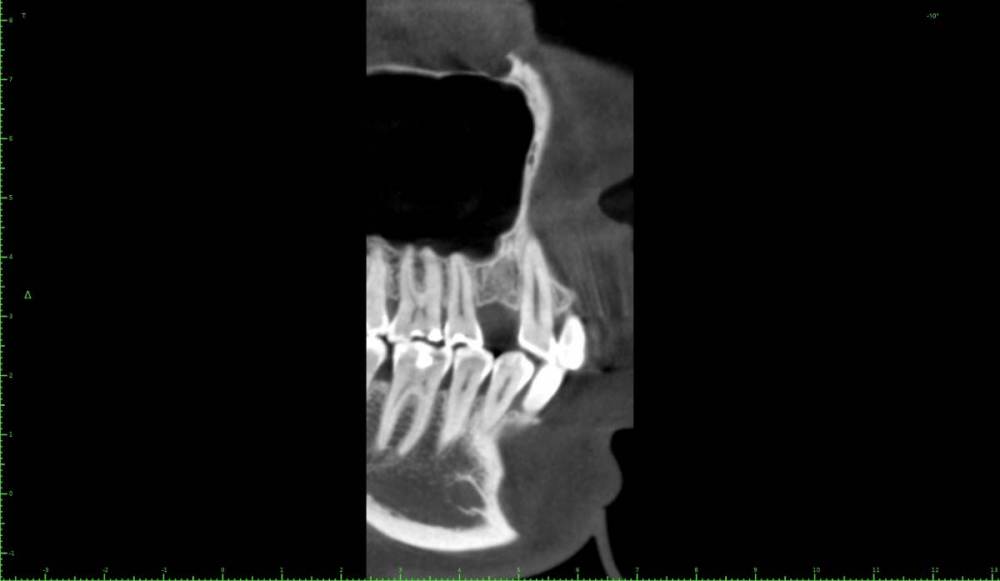 ������� ����� �����������0-Implant View.jpg