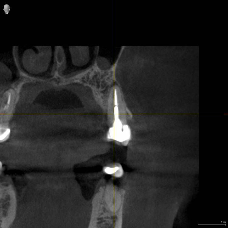 Iljaseviciene_Lina_3D-обследование(1)_VO1_20210507_090920_Трансверсальная проекция.jpg