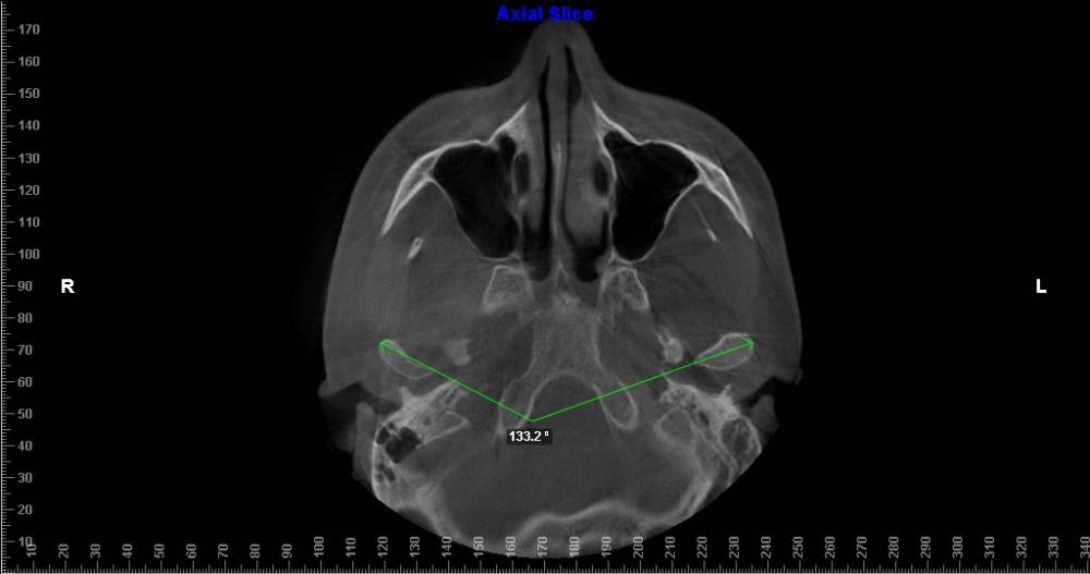 угол между суставными головками.jpg