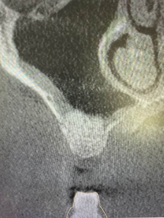 через 5 месяцев.jpg