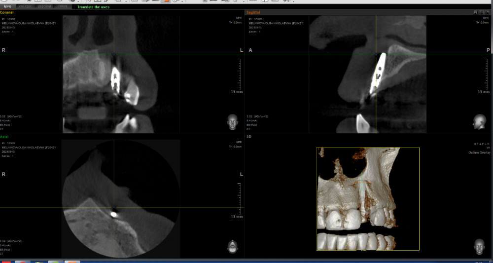 имплант 1.png