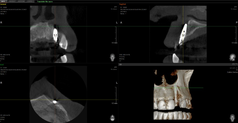 имплант 2.png