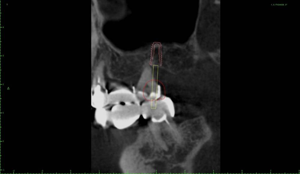 ����� �������� ������������0-Implant View.jpg