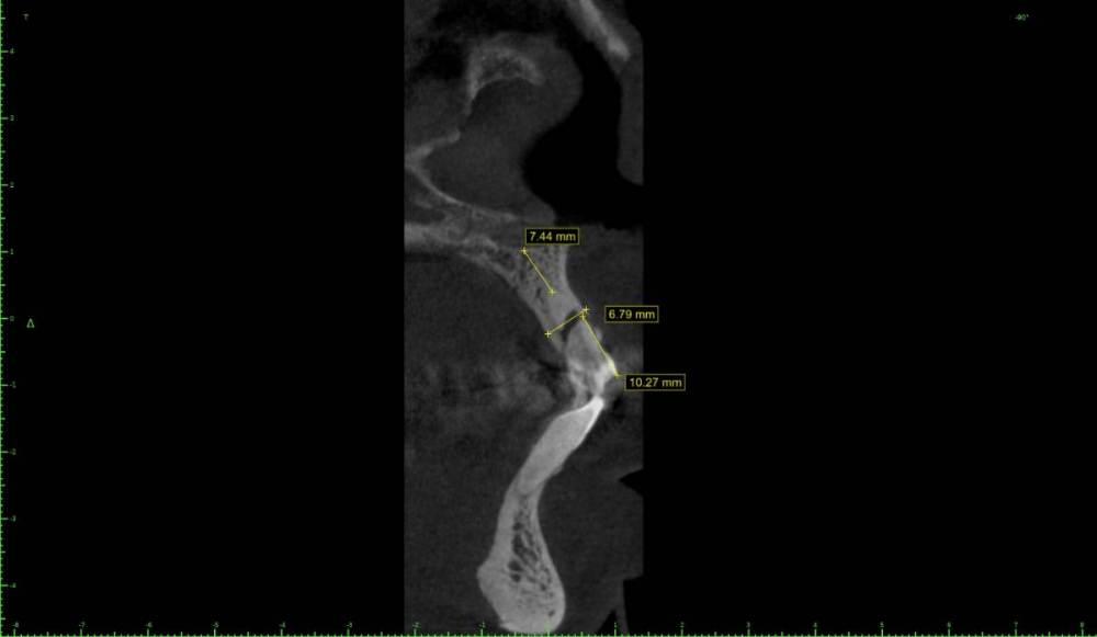 ������� ������ ��������������0-Implant View.jpg