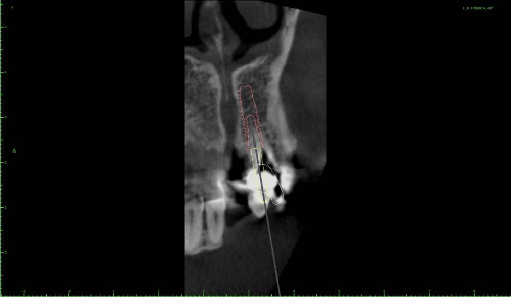 !1-Implant View.jpg