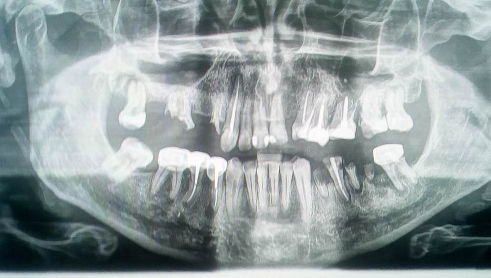 Панорама зубов_20190626_200130.jpg