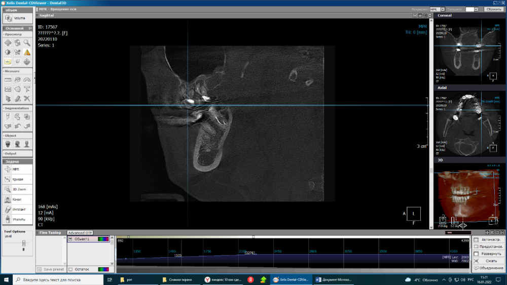 киста в 27.png