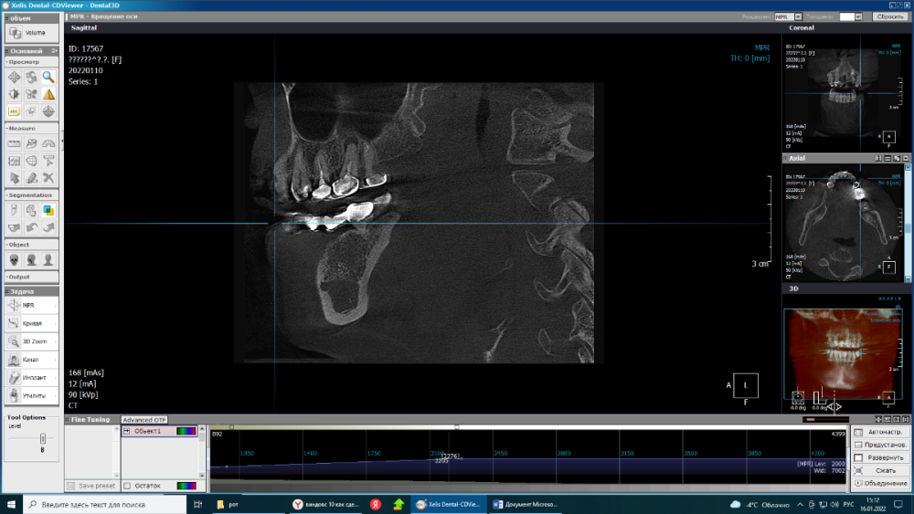 киста в 26.png