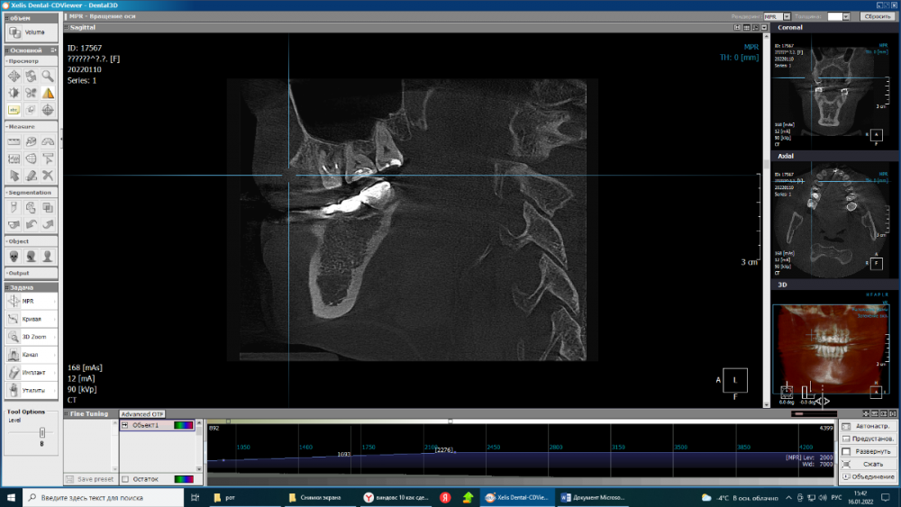 киста в 16.png