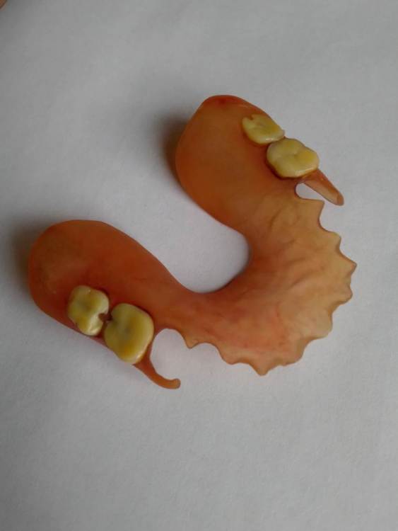 Нейлоновый протез Valplast 2005-2022.jpg