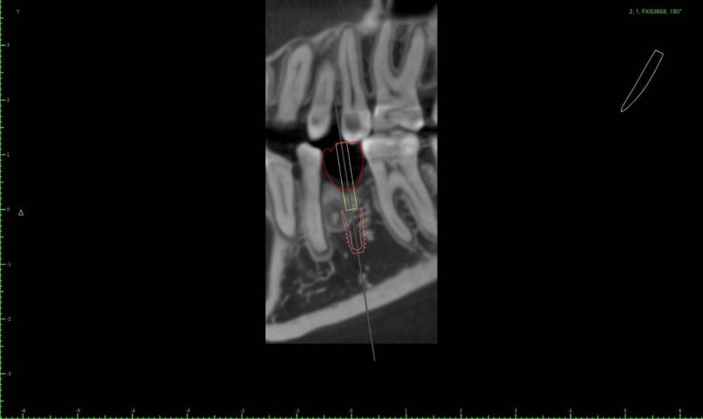 1235460-Implant View.jpg