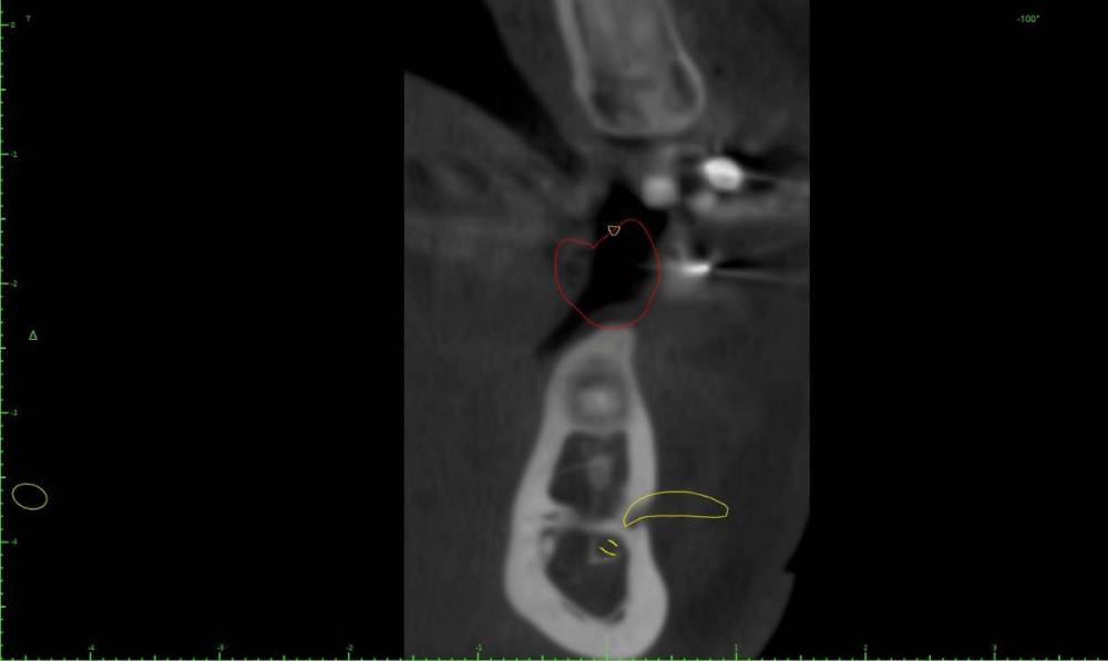 1235462-Implant View.jpg