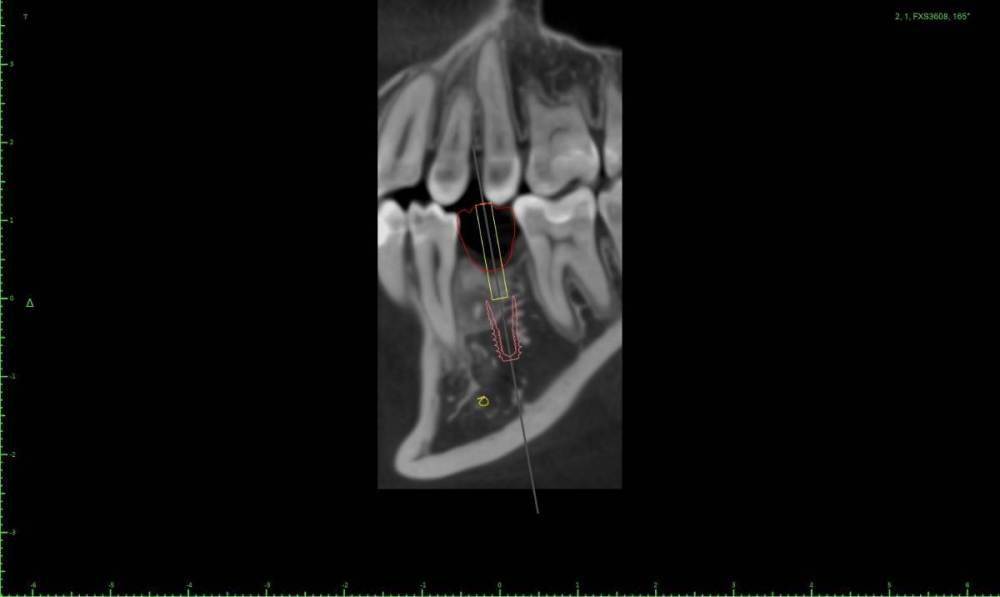 1235461-Implant View.jpg