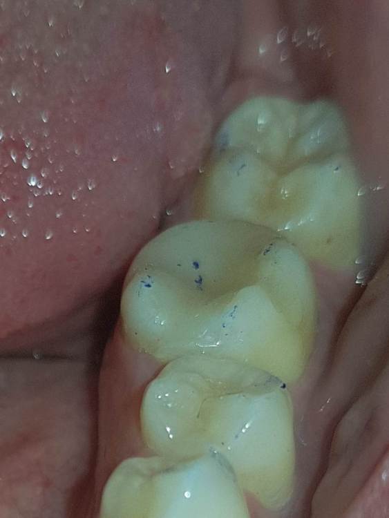 Нижний зуб.jpg