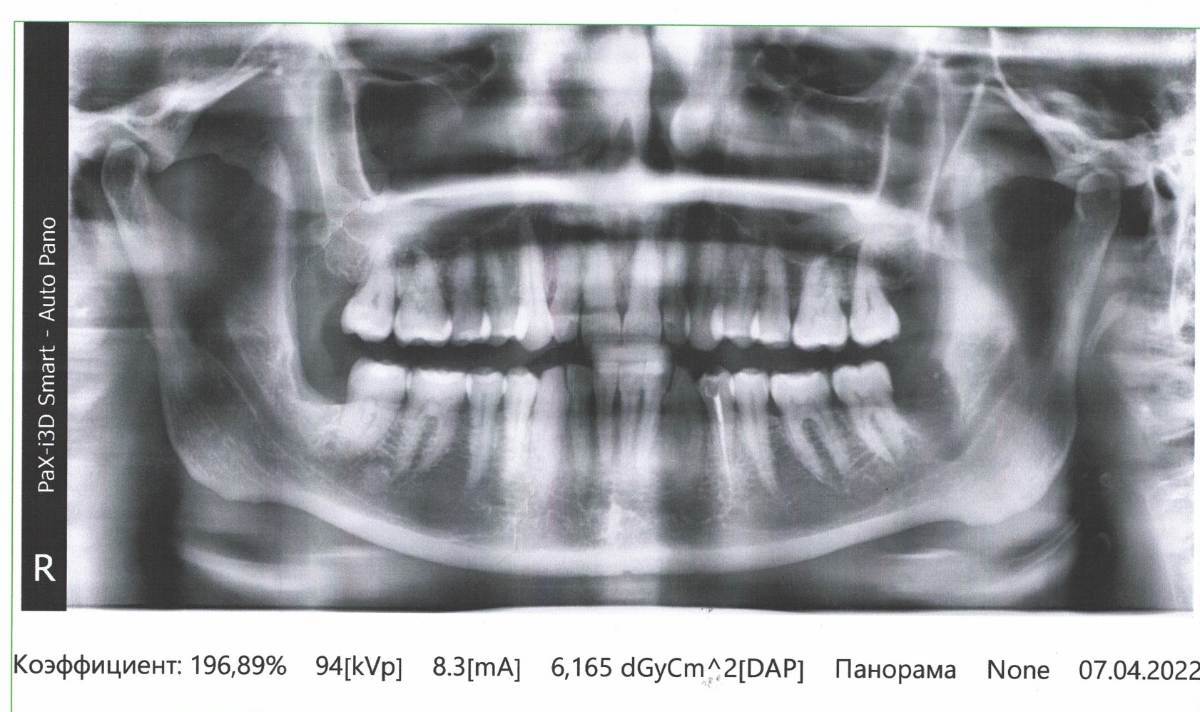 Пульсирующая боль в зубе. Причины и лечение