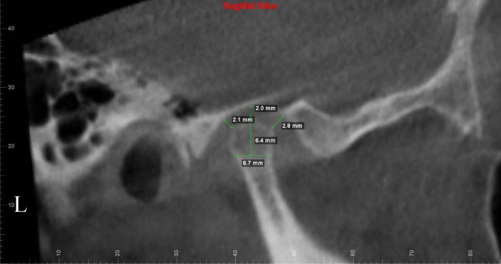 левый внчс сагиттальный срез.jpg