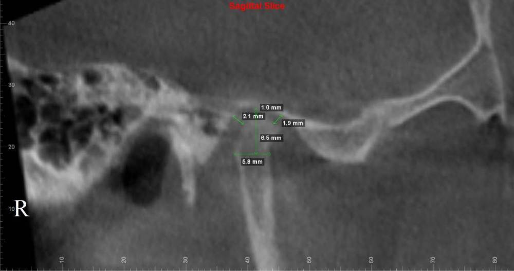 правый внчс сагиттальный срез.jpg