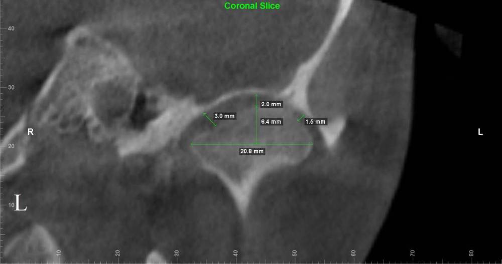 левый внчс корональный срез.jpg