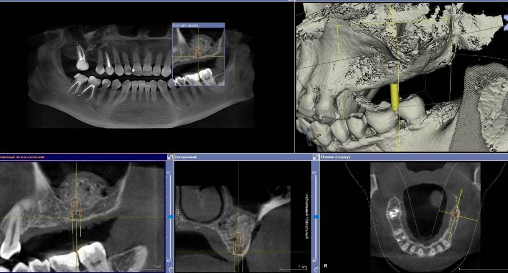 в день синуслифтинга.jpg
