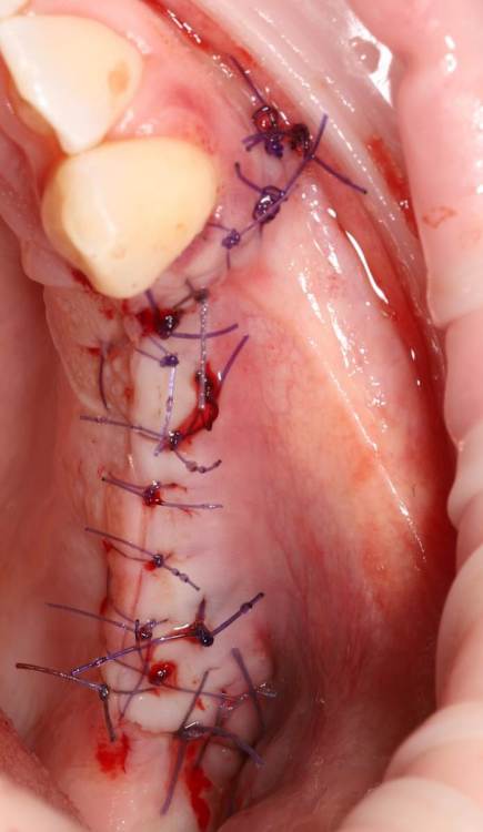 после сиуслифтинга.jpg