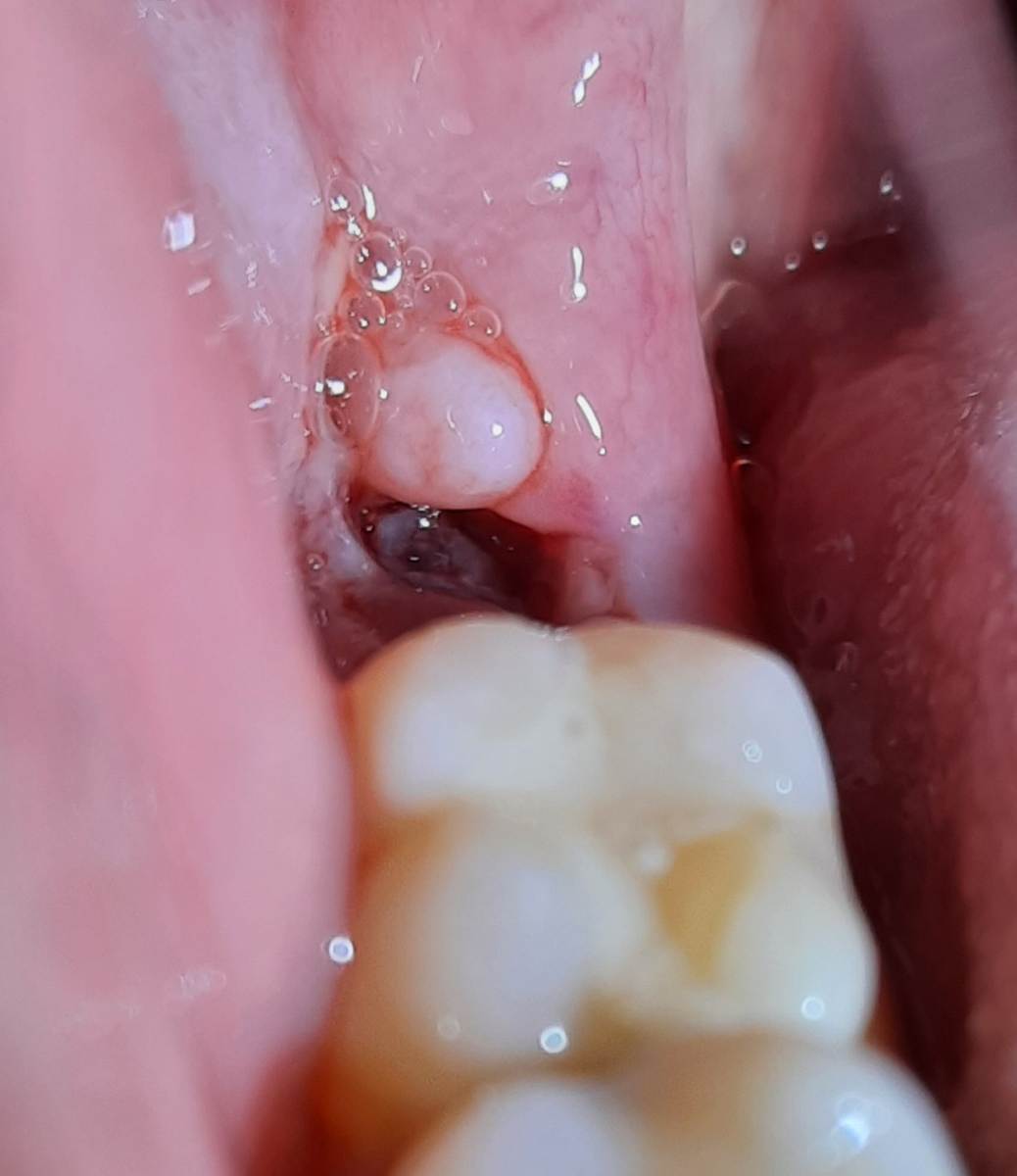 Сухая лунка зуба: незаметная проблема, требующая «скорой помощи»