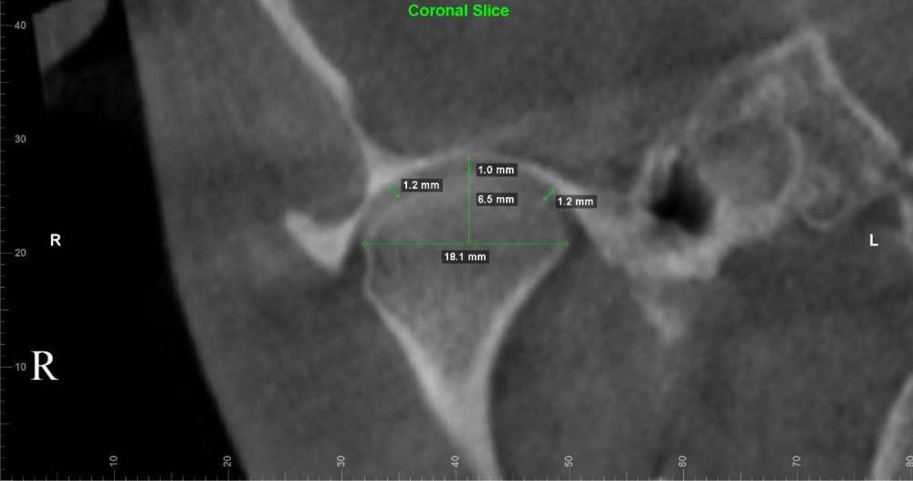правый внчс корональный срез.jpg