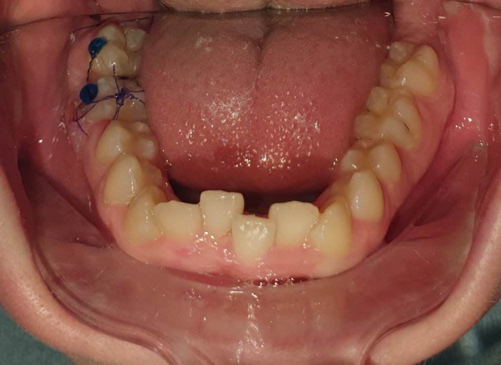 1. 09.11.2021 фиксация швами и шиной к 4.7.jpg