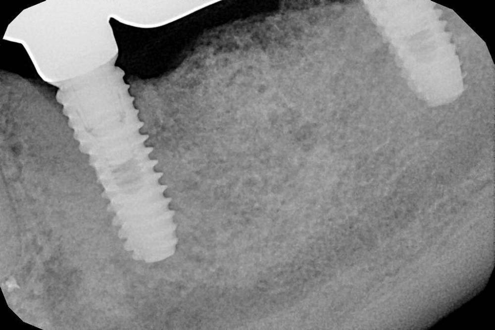 через 1 мес после прот 18г.jpg