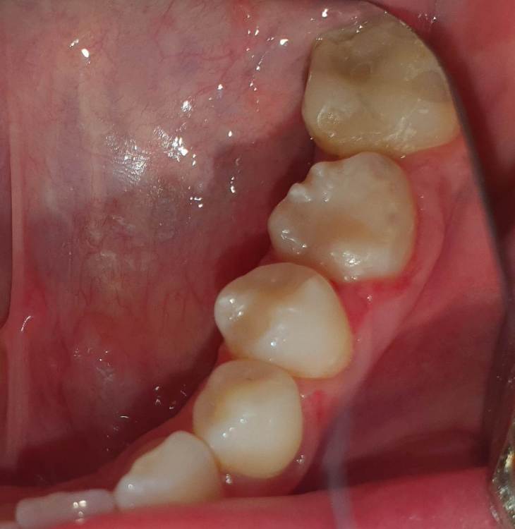 4. 14.07 снятие шины после эндо.jpg