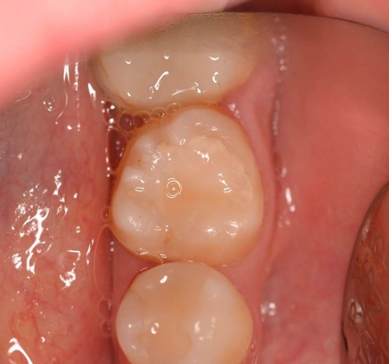 7.1 - осмотр через год.jpg