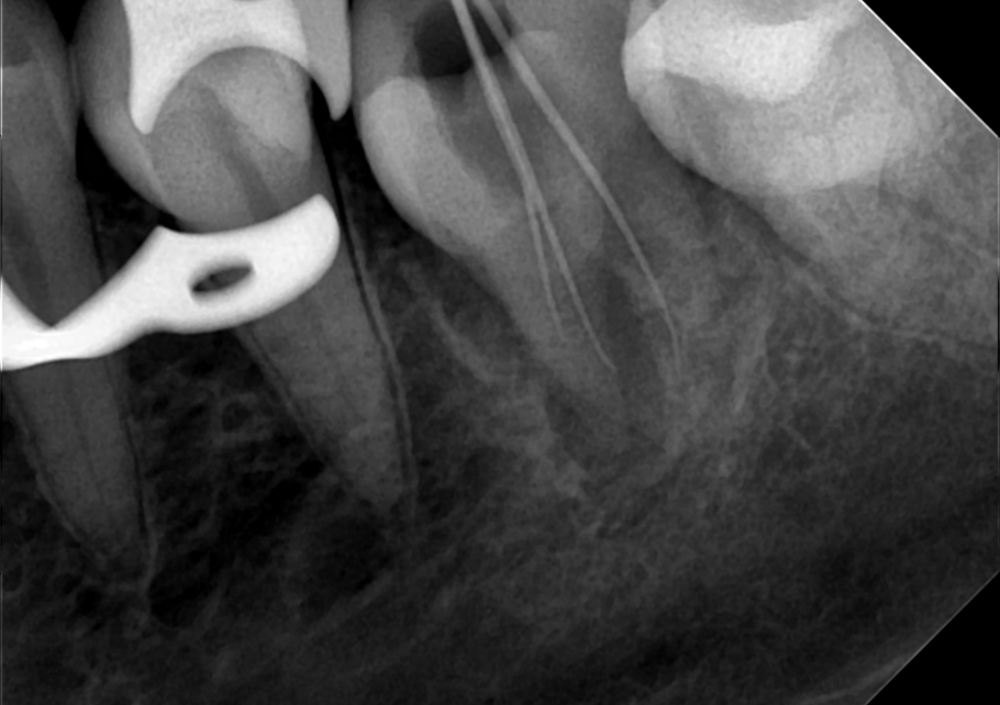 3. 3.6 14.07.22 в процессе эндо.png