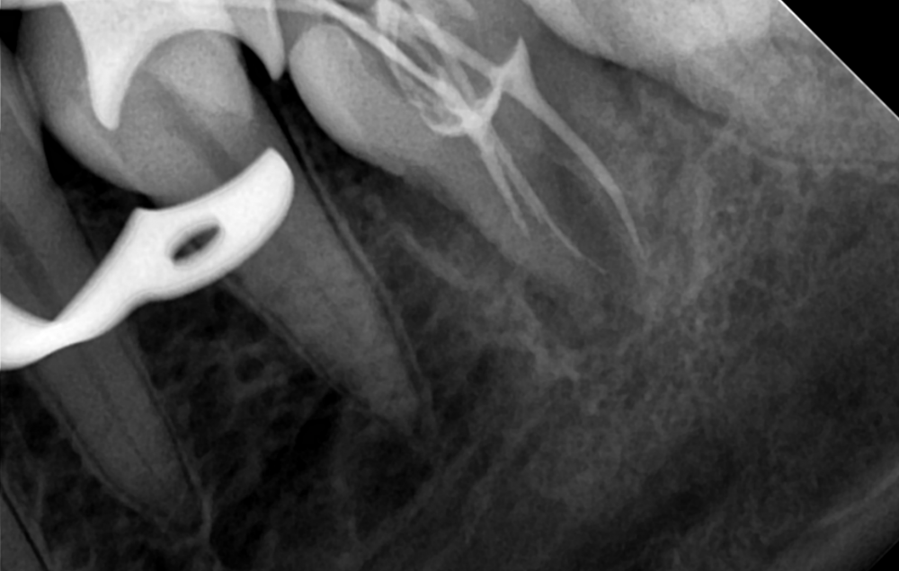 3. 3.6 пломбировка каналов 14.07.22.png