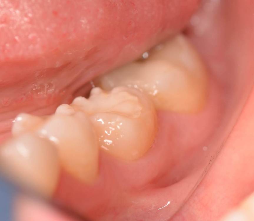 7.2 осмотр через год.jpg